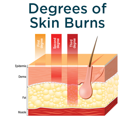 Degree of burns